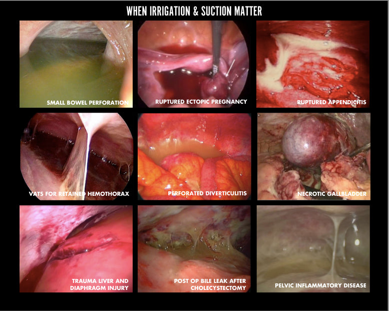 Vampiro - minimally invasive dual lumen poole suction sleeve (5/PK)